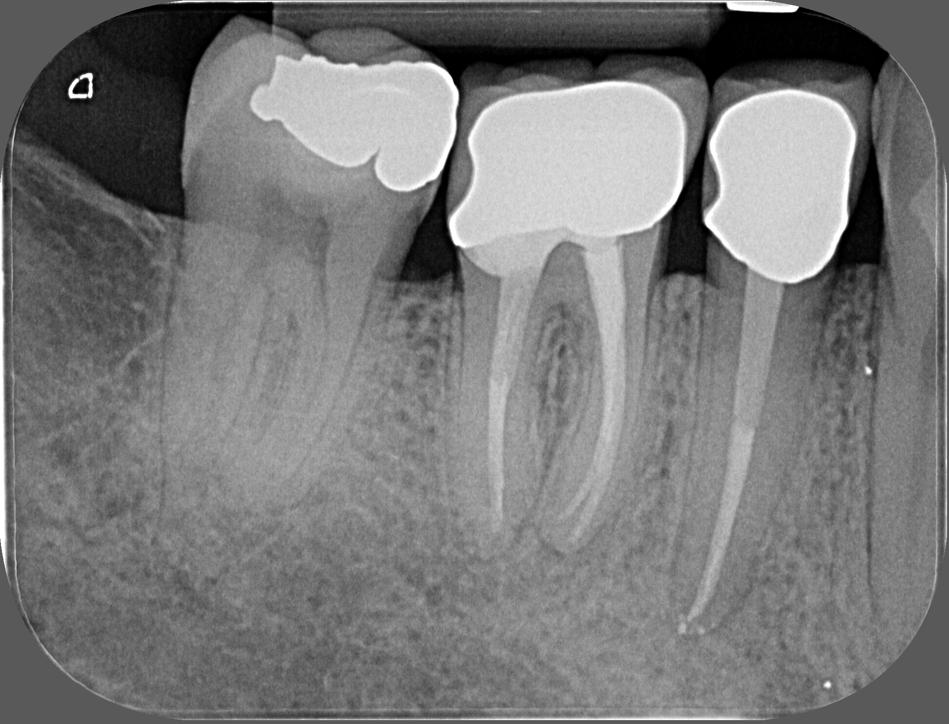Radio - traitement endodontique - dents 45 et 46